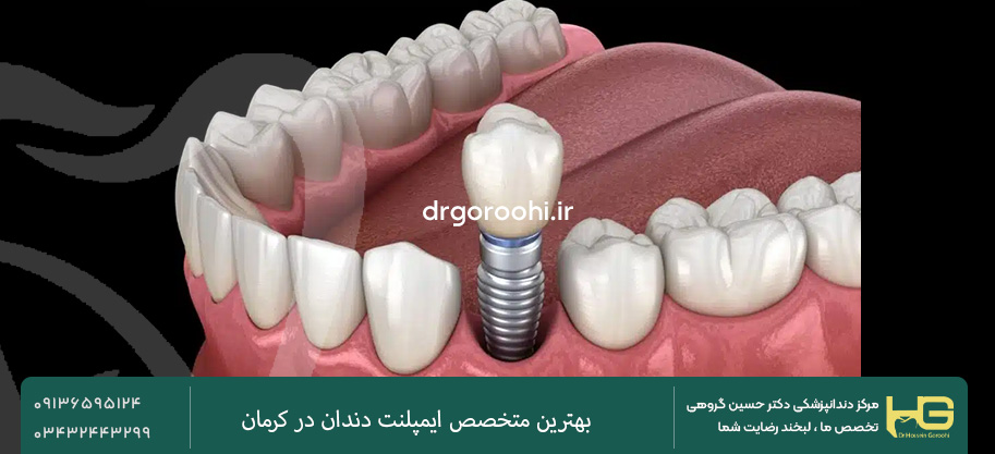 ایمپلنت دندان در کرمان