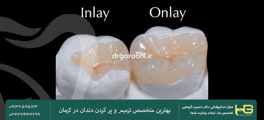 انواع مواد پر کردن دندان