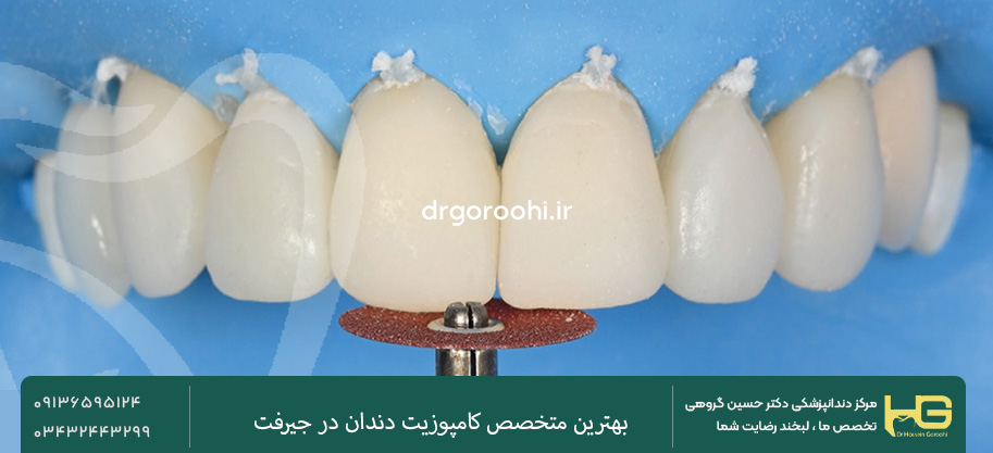 انواع کامپوزیت دندان