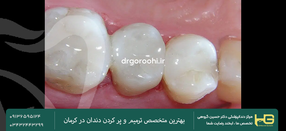 مواد پر کردن همرنگ دندان